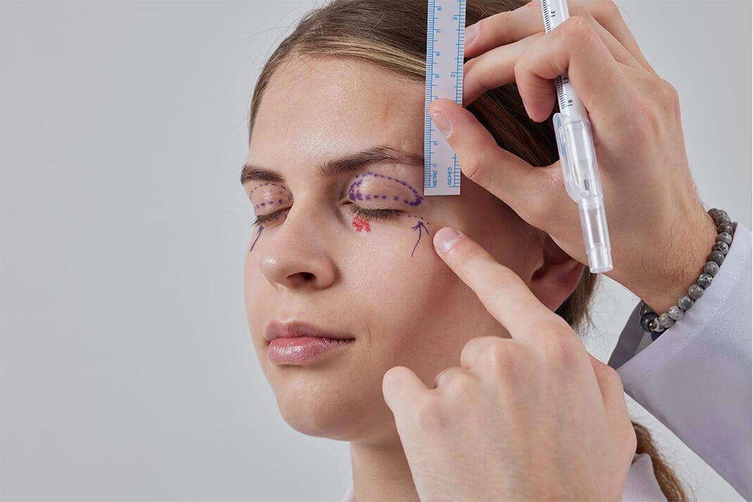 Blepharoplasty (Eyelid surgery) in Turkey