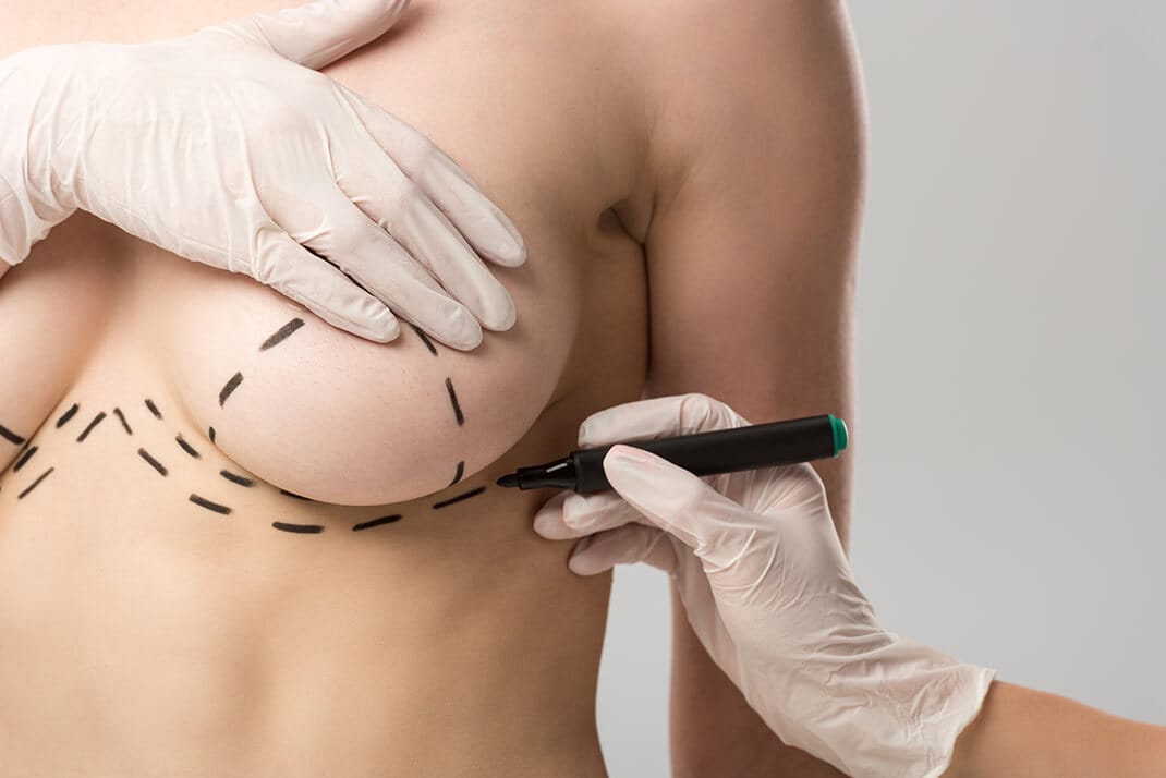 Breast lift (boob lift) in Turkey