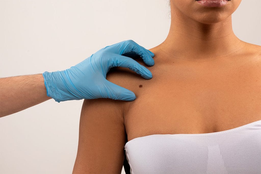Mole Removal (Nevus Excision) in Turkey
