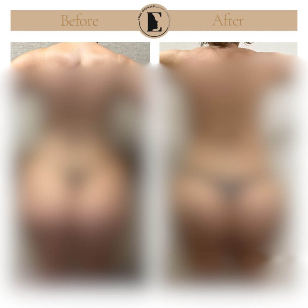 BBL (Popo büyütme) ameliyatı öncesi ve sonrası sonuçları