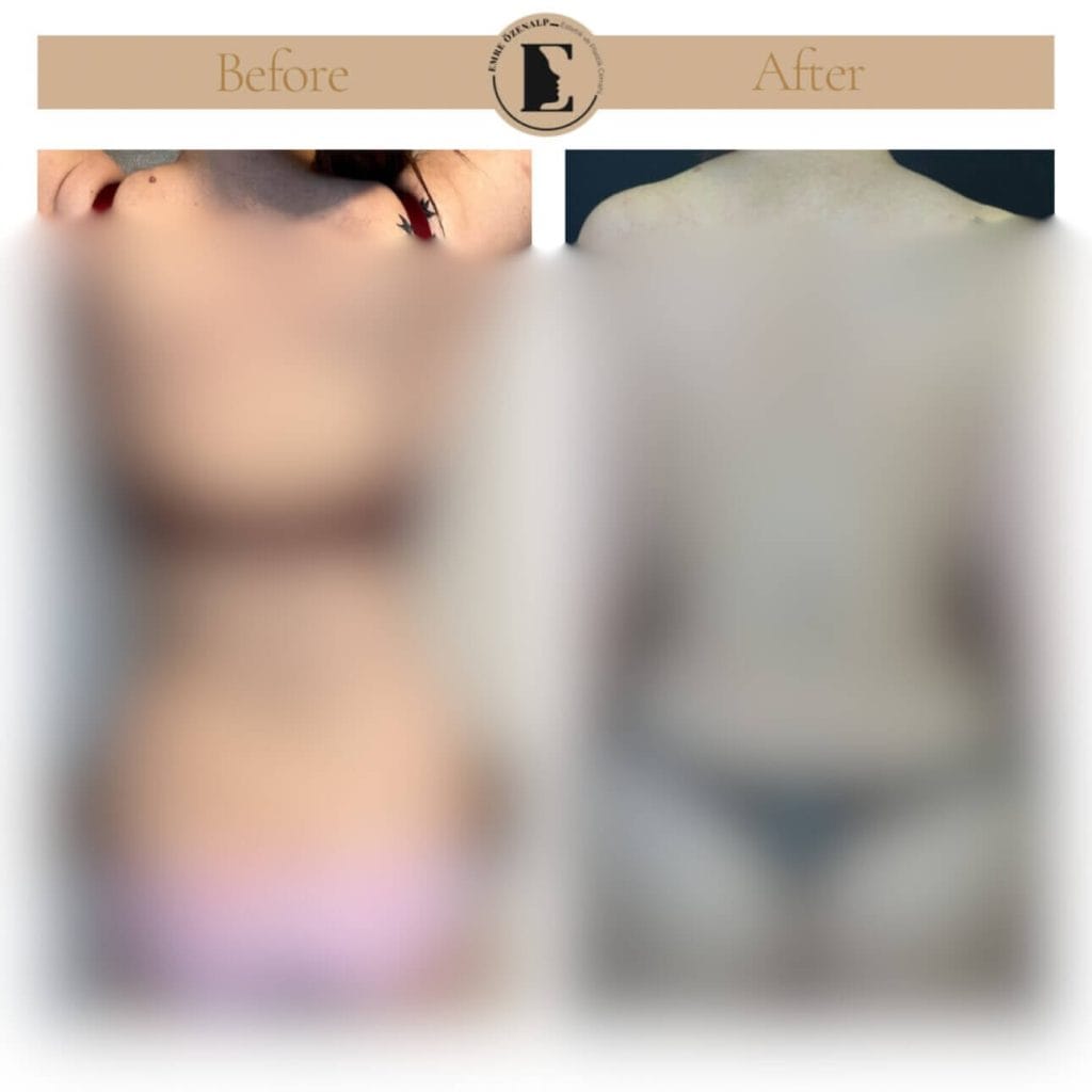 BBL (Popo büyütme) ameliyatı öncesi ve sonrası sonuçları