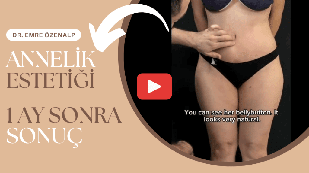 Annelik estetiği (mommy makeover) sonuç 1 ay sonra