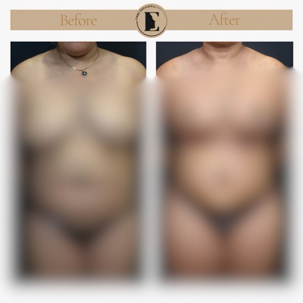 Annelik Estetiği (Mommy Makeover) Öncesi ve Sonrası Fotoğrafları