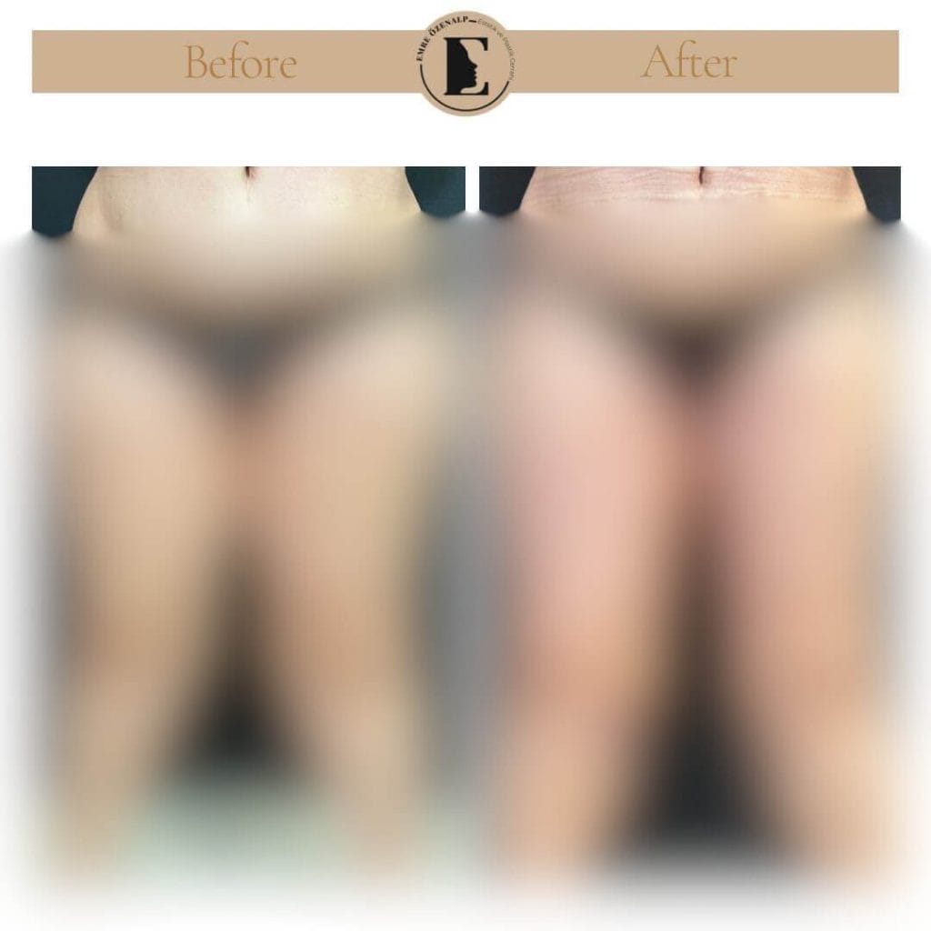 Bacak ya da uyluk germe ameliyatı öncesi ve sonrası sonuçları