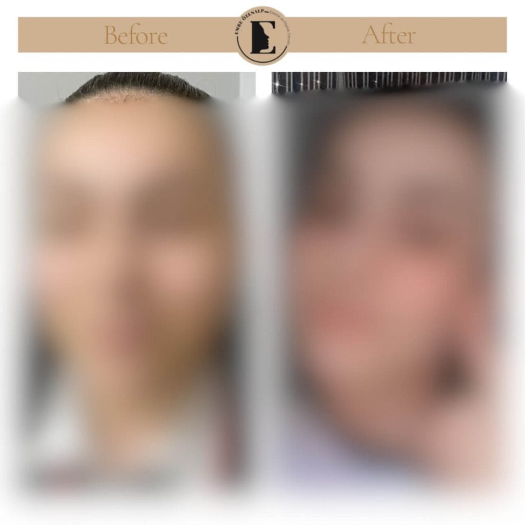 Gamze estetiği öncesi ve sonrası sonuçları