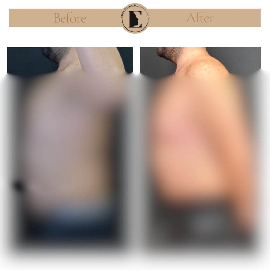 Jinekomasti (erkeklerde meme küçültme) ameliyatı öncesi ve sonrası sonuçları