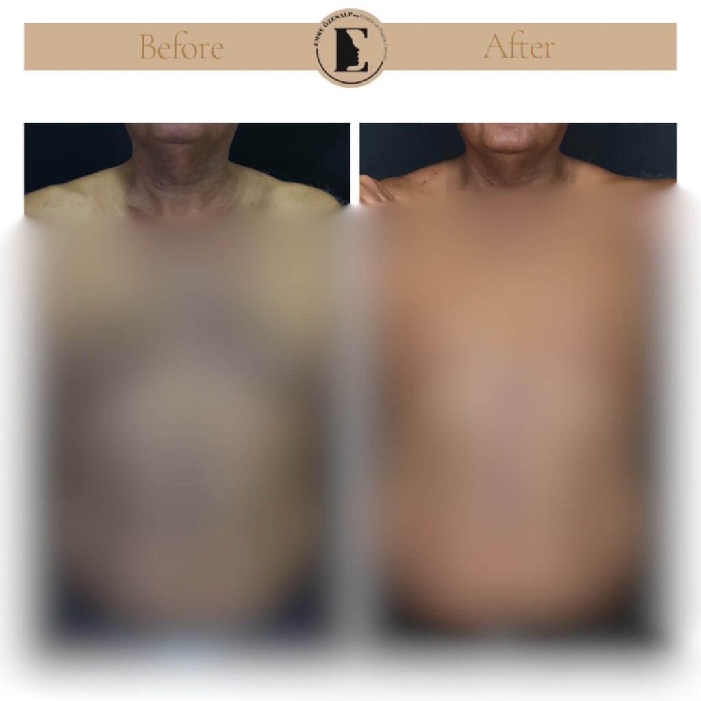 Jinekomasti (erkeklerde meme küçültme) ameliyatı öncesi ve sonrası sonuçları