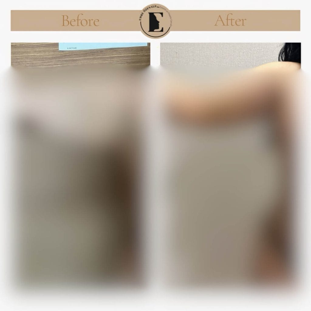 Kol germe ameliyatı öncesi ve sonrası