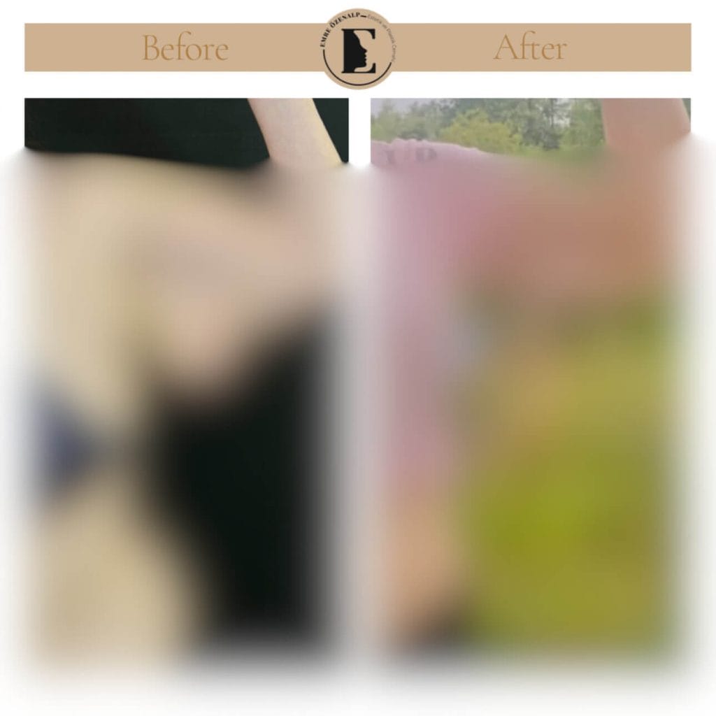 Kol germe ameliyatı öncesi ve sonrası