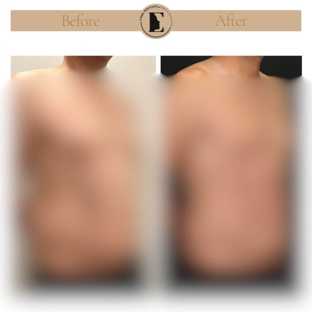Liposuction öncesi ve sonrası sonuçları