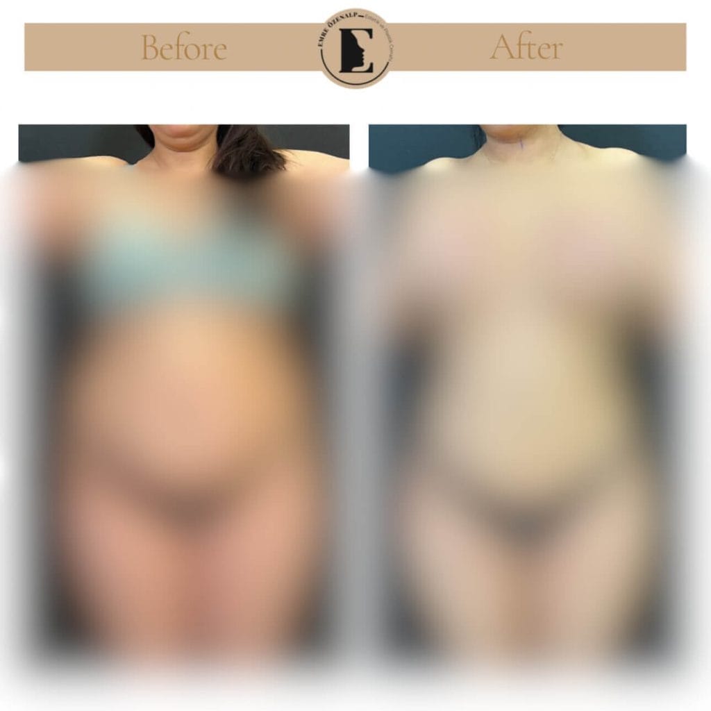Liposuction öncesi ve sonrası sonuçları