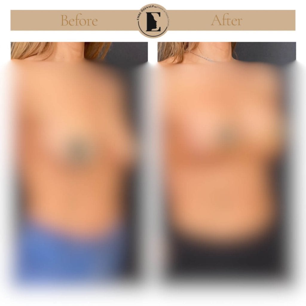 Meme dikleştirme ameliyatı öncesi ve sonrası sonuçları