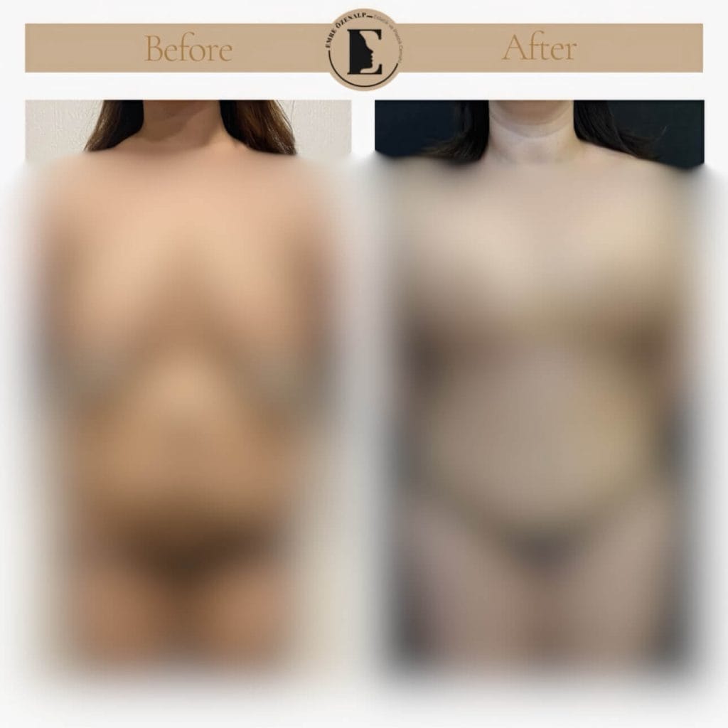 Meme küçültme ameliyatı öncesi sonrası fotoğrafları ile sonuçları inceleyebilirsiniz