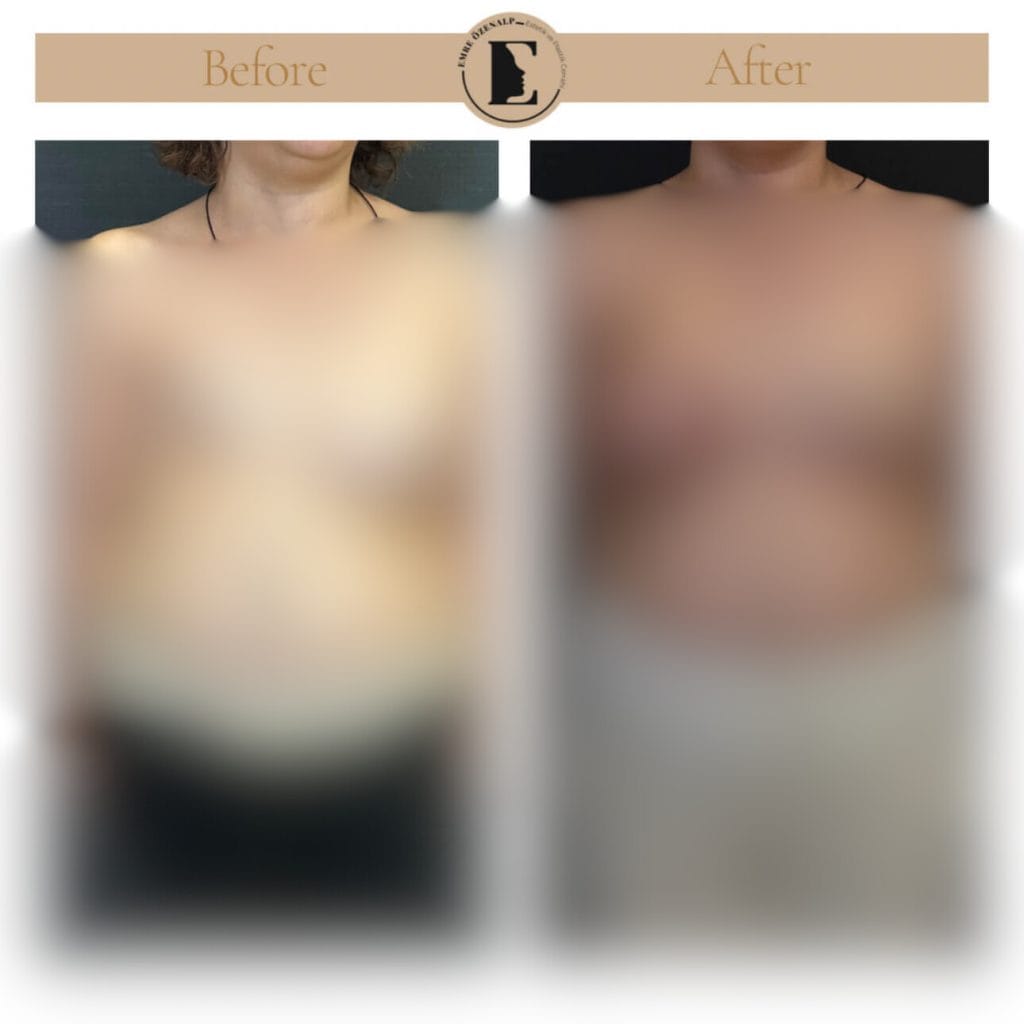 Meme rekonstrüksiyonu ameliyatı öncesi ve sonrası sonuçları