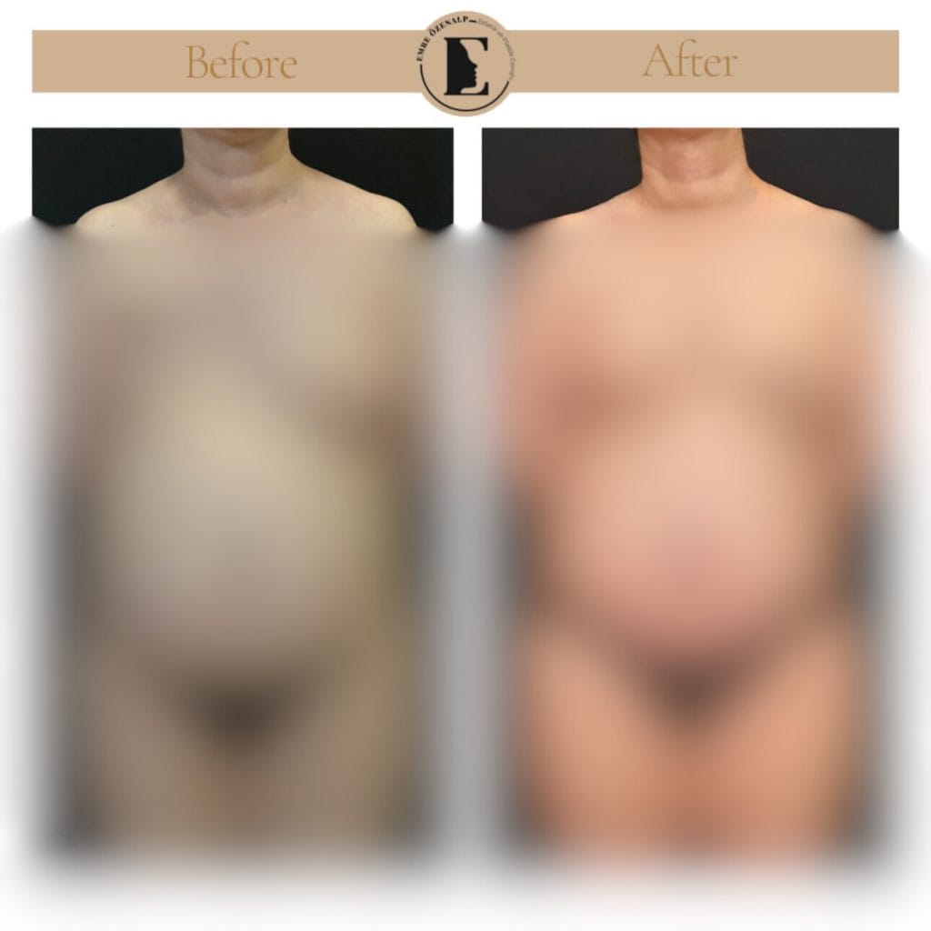 Meme onarımı ameliyatı öncesi ve sonrası sonuçları