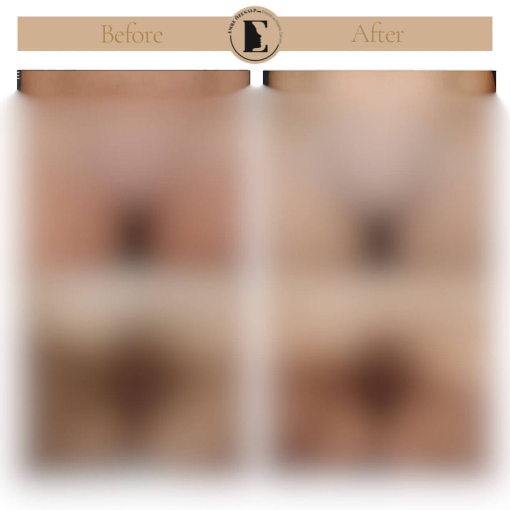 Vajina daraltma ameliyatı öncesi ve sonrası sonuçları