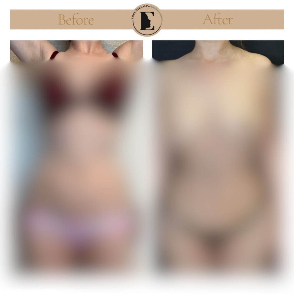 Yağ enjeksiyonu öncesi ve sonrası sonuçları