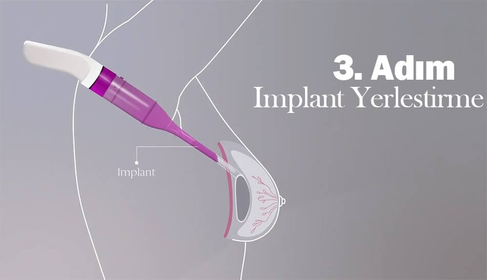 MIA Femtech meme büyütme 3. adım: Implant yerleştirme