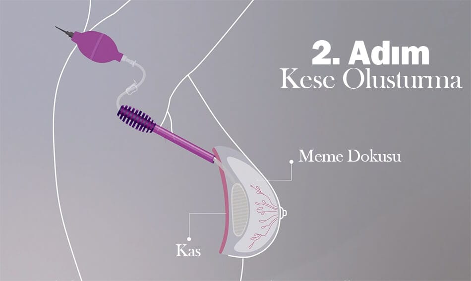 MIA Femtech meme büyütme 2. adımı: kese oluşturma
