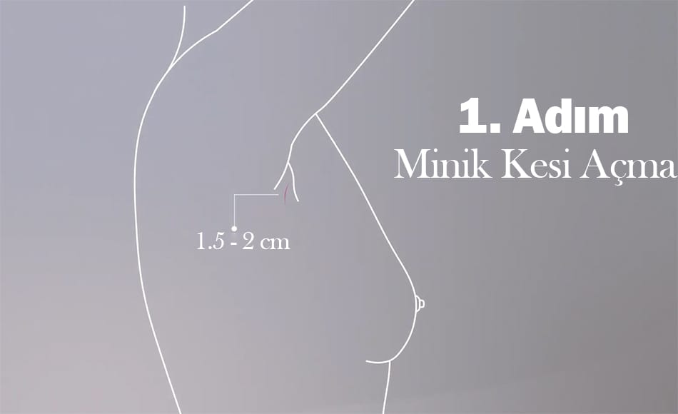 Mia Femtech ilk adım olan koltuk altından minik kesi oluşturma