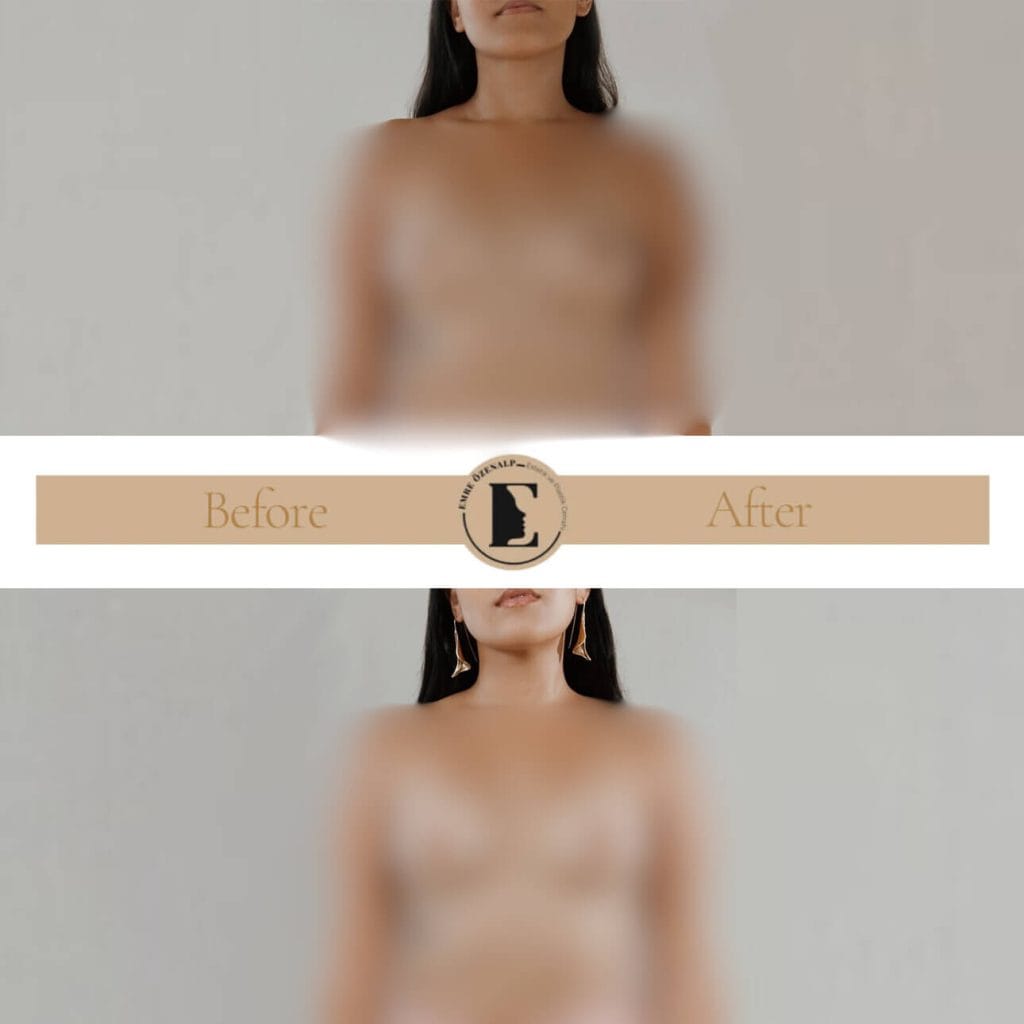 MIA Femtech implant ile meme büyütme öncesi ve sonrası sonuçları