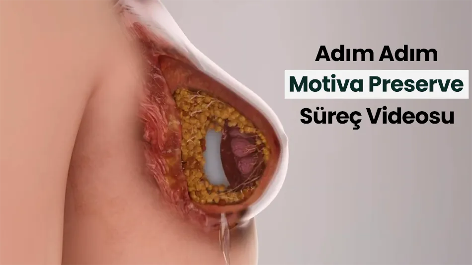 Motiva Preserve yöntemiyle mem ebüyütme operasyonu adım adım süreç videosu